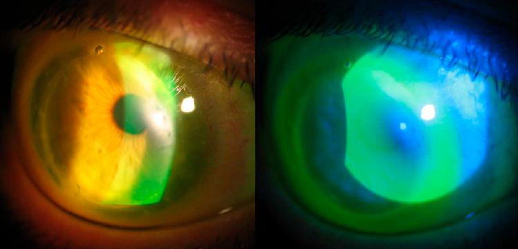 Solomon A. - Склеральні контактні лінзи для реабілітації зору після наскрізної кератопластики - 04.jpg (23 KB)
