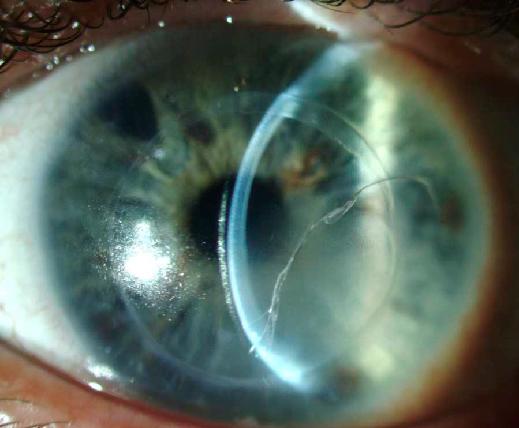 Solomon A. - Склеральні контактні лінзи для реабілітації зору після наскрізної кератопластики - 03.jpg (48 KB)