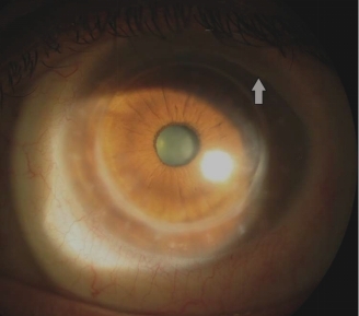Solomon A. - Склеральні контактні лінзи для реабілітації зору після наскрізної кератопластики - 05.jpg (48 KB)