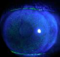Solomon A. - Склеральні контактні лінзи для реабілітації зору після наскрізної кератопластики - 06.jpg (3 KB)