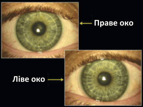 Рисунок 1. Фотографія кожного ока пацієнта з лінзами Soft K II